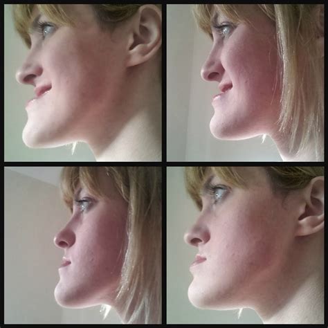 A Wimps Guide To Orthognathic Surgery Double Jaw Surgery Results