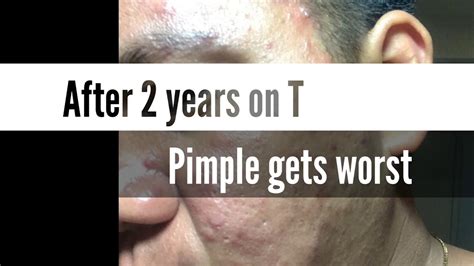 Pimple Breakout Side Effects On Hrt Youtube