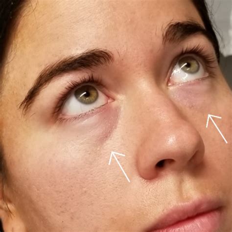 Redensity Ii Under Eye Treatment Before And After Photos