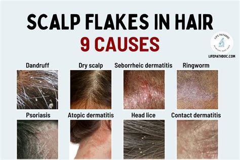 Scalp Flakes In Hair Dandruff And 8 Other Causes