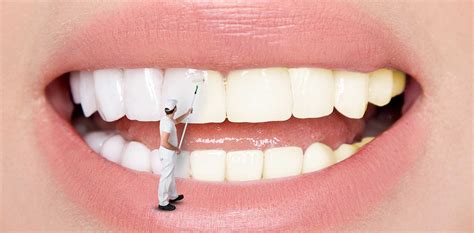 How to use teeth whitening gels to remove stains at home. How To Remove Stains From Teeth: Natural And Professional ...
