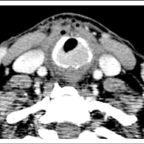 Computed Tomography Ct Scan Showed A Cricoid Cartilage Mass 24 Â 16