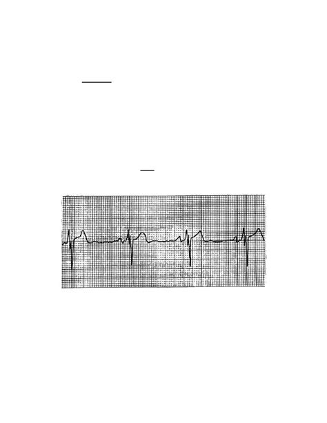 Figure 2 13 Sinus Bradycardia Cardiac Impairment