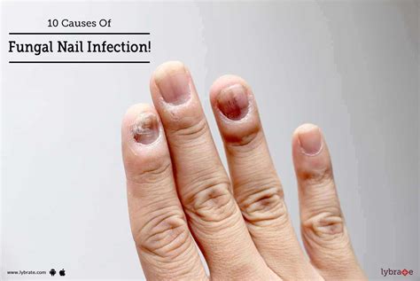 10 Causes Of Fungal Nail Infection By Skinovate Laser And Cosmetic
