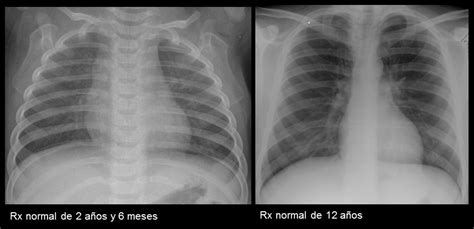 Continuum Radiograf A De T Rax Indicaciones Diagn Stico Y Casos Pr Cticos