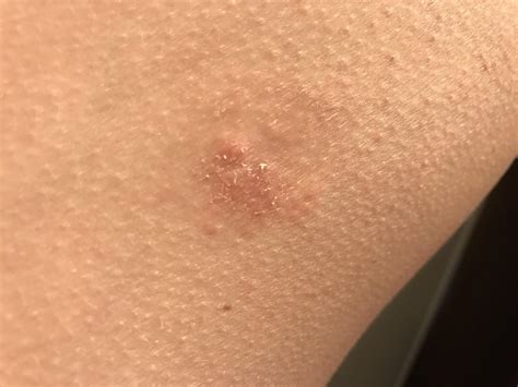 Patch Of Dry Skin On Hand