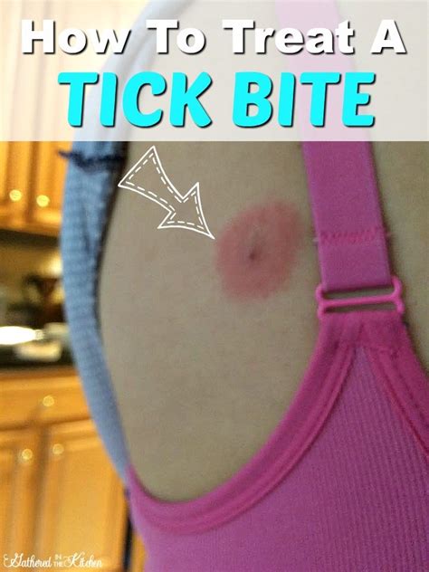 What To Do If You Get A Tick Bite Gathered In The Kitchen