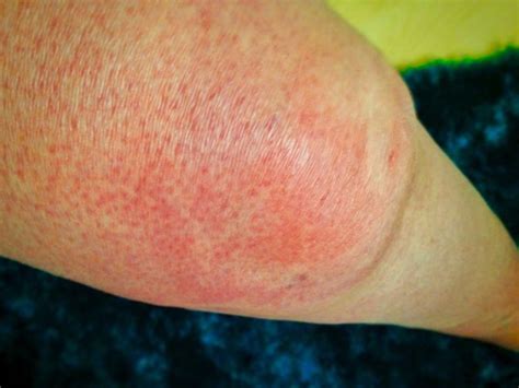 Allergies Rash Swollen Knee In Pic Hives Is An Itchy And Painful Rash