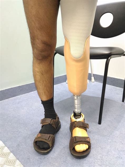 Below Knee Prosthesis Below The Knee Amputation Orthotics And