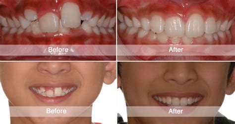 Before And After Viva Orthodontics