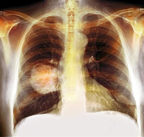 lung cancer x ray photograph by science photo library fine art america