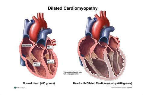 Cardiomyopathy Types Nhlbi Nih