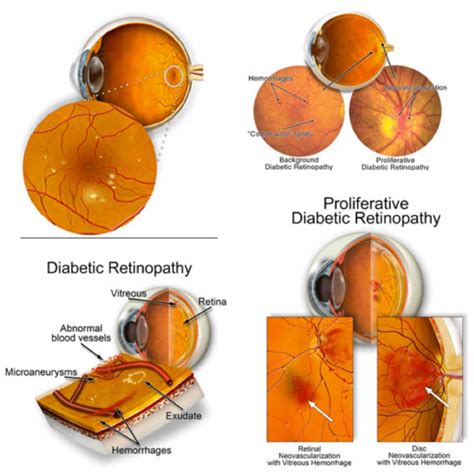 Stage four diabetic retinopathy is the most advanced stage of diabetic retinopathy, during which new blood vessels begin to grow on the retina. Diabetic Retinopathy - Retina Foundation of Canada