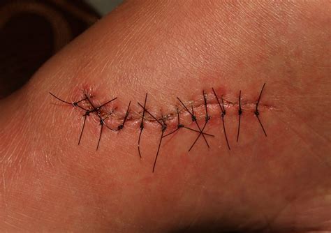 We did not find results for: Dissolvable Stitches - Features, Pictures, How they Work