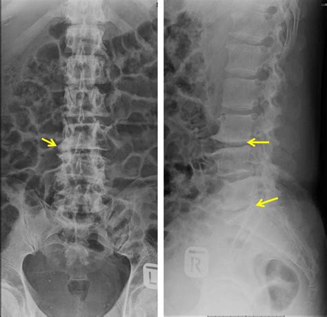 Pyogenic Spondylodiscitis With Paraspinal Abscess Radiology Cases