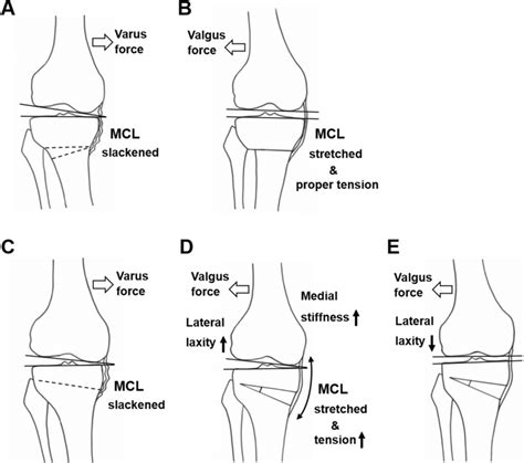 Difference Between Closed Wedge High Tibial Osteotomy Cwhto A B And