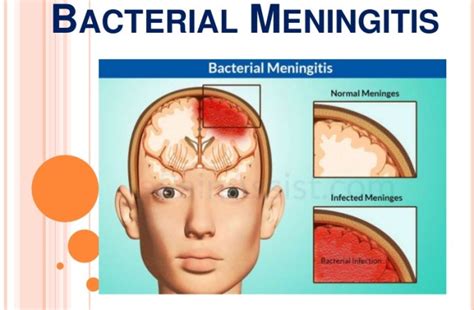 All You Should Know About Bacterial Meningitis Elsieisy Blog