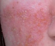 Despite intensive topical therapy, treatment with oral corticosteroids and oral doxycycline was unable to achieve suff … Rosacea, Akne oder andere Hautkrankheit? (Gesundheit ...