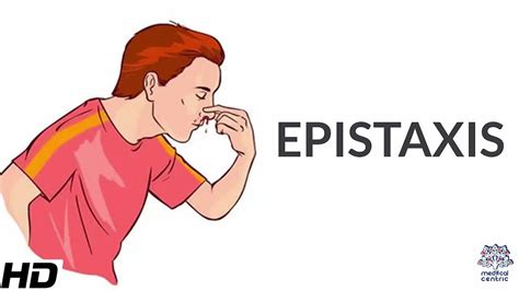 Epistaxis Causes Signs And Symptoms Diagnosis And Treatment Youtube