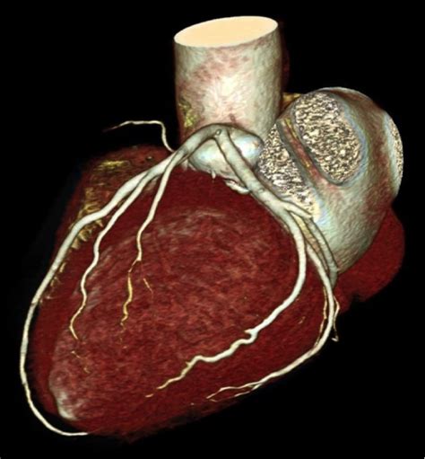 Heart Calcium Scan Coronary Artery Calcium Score Preventclinic Inc