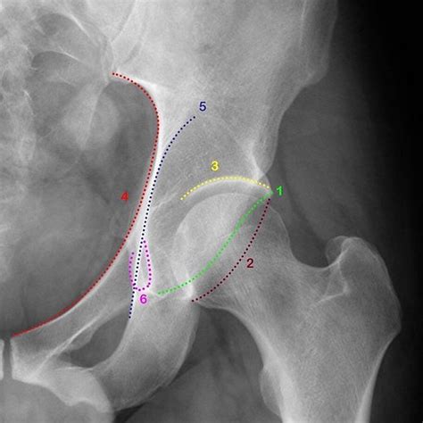 Radiographic Anatomy Of The Acetabulum By Dr Benoudina Sam Flickr