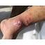 Staph Infection  Causes Symptoms Prevention Treatment Contagious