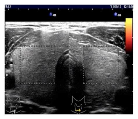 A Ultrasonic Study Of The Thyroid Revealing Mild Swelling With 69 Mm