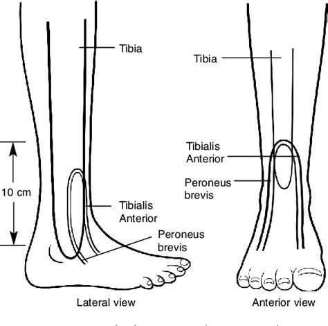 Figure 14 4 From Common Peroneal And Posterior Tibial Nerve Paralysis