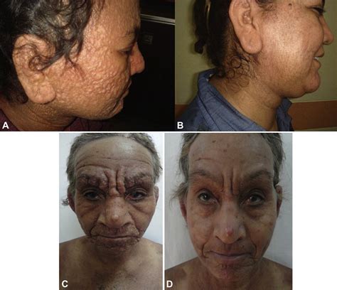 Scleromyxedema A Novel Therapeutic Approach Journal Of The American