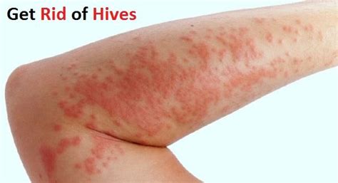 What can you do to prevent hives? How to Get Rid of Hives?