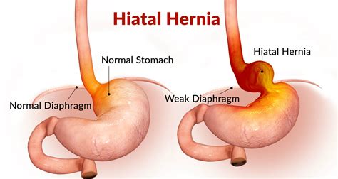 Hiatal Hernia Causes Symptoms And Treatments
