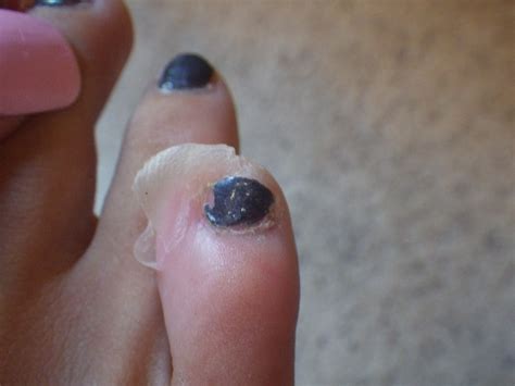 Planks, Fartleks, and Family Fun: Got Grossness?? We Do ... Alibaba.com offers 1,881 black toe nail products.