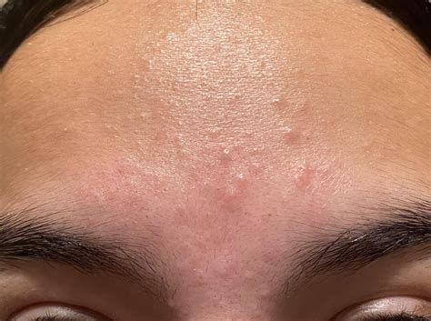 Weird Bumps On Forehead Rskincareaddicts