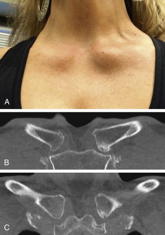 Disorders of the Sternoclavicular Joint | Musculoskeletal Key