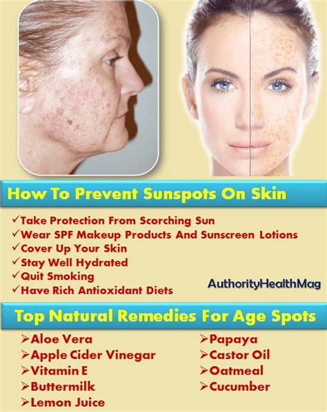 Sunspots On Skin And Face Sunspot Removal Remedies