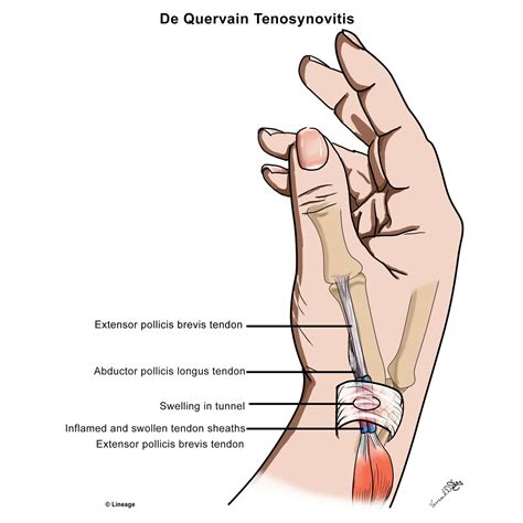 De Quervain Tenosynovitis Msk Medbullets Step 1