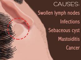 Lymph nodes are found in the neck, armpits, chest, abdomen, and groin. Lump Behind the Ear | Lump behind ear, Ear, Swollen lymph ...