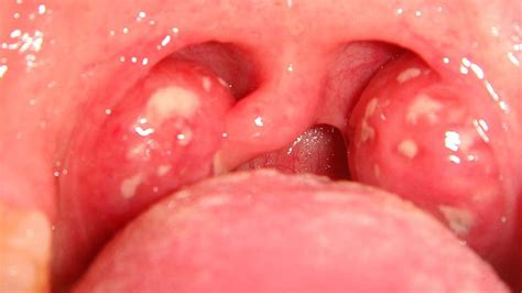 Throat cancer is a type of head and neck cancer that involves the pharynx and the larynx. علاج التهاب الحلق الشديد