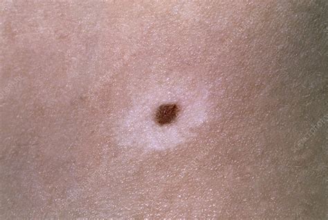 Vitiligo Seen Around A Pigmented Naevus Stock Image M2900093