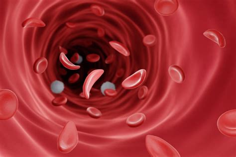 Anemia sierpowata jak się objawia Przyczyny i leczenie