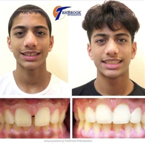 How Braces Change Face Shape Before And After