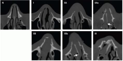 Your nose has 2 bones at the bridge of your nose and a long piece of cartilage (flexible but strong tissue) that gives your nose a nasal fracture occurs when the bony part of your nose has been broken. Nasal Bone Ct Scan Anatomy - ct scan machine
