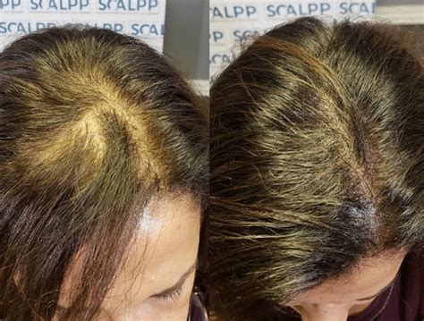 If you have thinning hair, you're certainly not alone. Scalp Micropigmentation For Women | Hairloss and Thinning ...