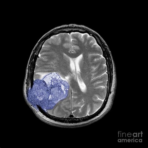Malignant Brain Tumor 1 Of 3 Photograph By Living Art Enterprises