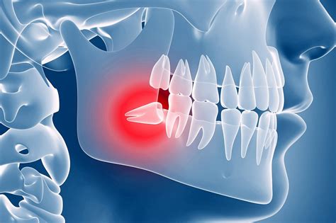 Many modern humans lack these third molars entirely. Wisdom Teeth Removal - 5 Awesome Tips for Recovery