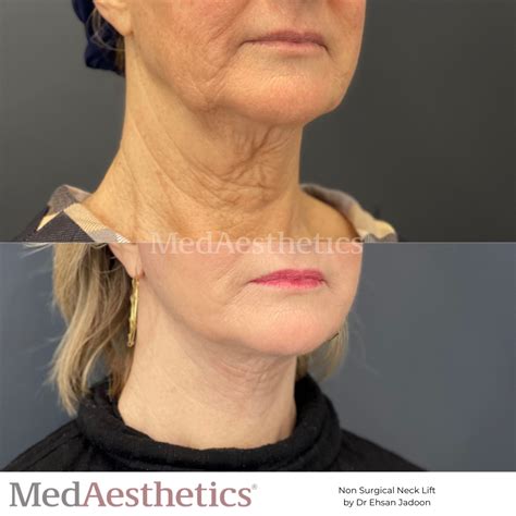 Non Surgical Face Lift Thread Lift In Perth