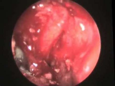 Jul 15, 2021 · diagnostic criteria for allergic fungal sinusitis include type 1 hypersensitivity, nasal polyposis, characteristic ct scan, histologic evidence of eosinophilic mucus without evidence of fungal. Fungal Sinusitis - YouTube