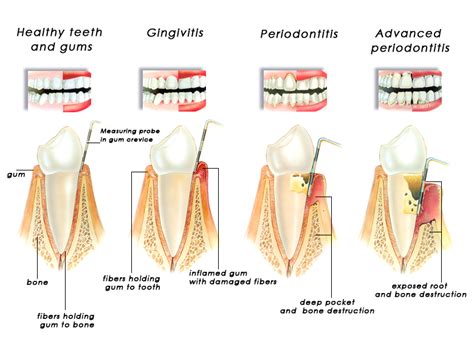 Gum Disease Gingivitis Prestige Dental My