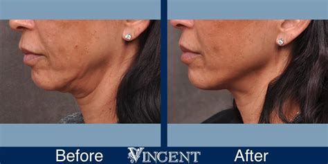 Vincent Surgical Arts Profound Treatment In Cottonwood Heights