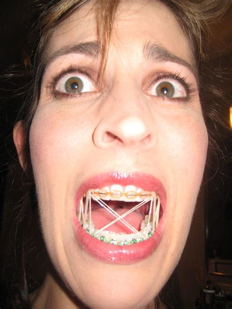 Lessons Ive Learned Wearing Braces 1 Bands Can Be Frigh Flickr